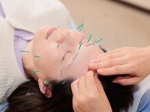 藤田はりきゅう治療院/美容鍼コースでの鍼施術