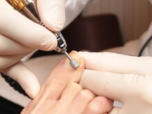 巻き爪研究所 表参道院/爪の表面にプレート貼ります