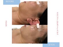 ソユ(SOYOU)/施術* 　９Dリフト