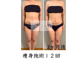 アイ エステサロン(Ai)/【30代】産後ダイエット腰回り