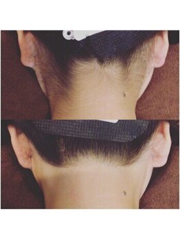 クラリティー 阿佐ヶ谷店(CLARITY)の写真/美容師・看護師プロデュースの脱毛★大人気のうなじ脱毛◎美容院で剃られてしまう方やまとめ髪にもお勧め♪