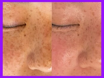 ヴィオール 名古屋栄店(VIOR)/-7歳肌♪ 若々しく印象UP♪