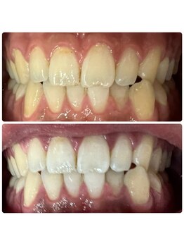 ラブホワイトニング 渋谷店(LOVEホワイトニング)/初回3回照射ホワイトニング