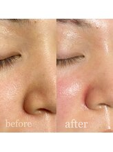 エトレ(ETOLE)/毛穴洗浄♪