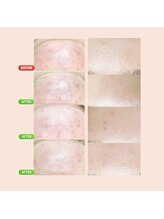 サロン ド マハロ(Salon de MAHALO)/毛穴エクストラクション