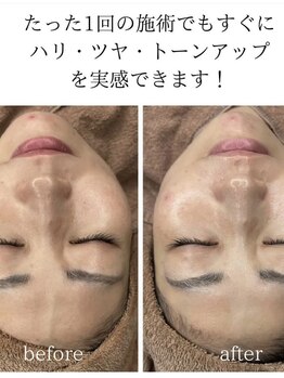 ピョル(pyoru)/大人気ララピール☆