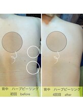 ガーデン(Garden)/背中ハーブピーリング2