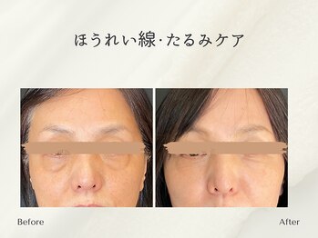 ホリスティックサロン ヘルバ(Holistic salon Herba)/ほうれい線・たるみケア施術変化