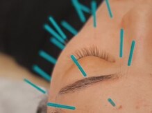 リボディ美容鍼灸院(Re±body美容鍼灸院)の雰囲気（美容鍼）