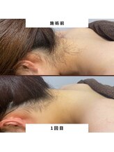 ミース 北九州店/うなじ★ビフォーアフター