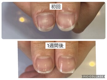 アンドネイル 海老名(&nail)/育成ネイルケア1週間の変化