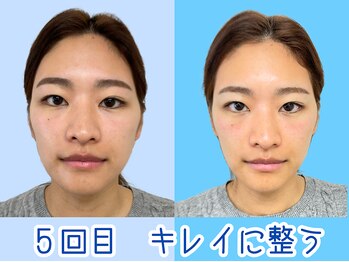 ナチュラルビューティーフェイス 横浜(NBF)/５回目/小顔矯正横浜駅