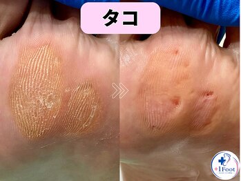 プラスワンフット 本厚木(+1 Foot)/タコ・魚の目ケア！痛みから解放