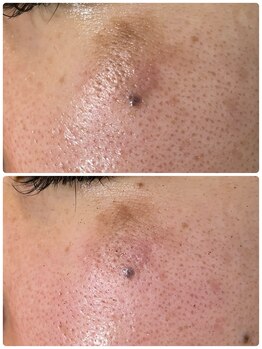 ラティメリア(Latimeria)/気になる部分にハーブピーリング