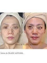 サロン ド ブラン アオヤマ(Salon de BLANC AOYAMA)/立体感フェイス