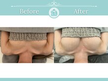 美人バスト 小倉店/バストアップ◇症例◇