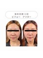 ワンモア 新町店(1MORE) ダイエットしても顔が小さくならないお悩みお客様