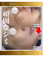 顔凛(カオリン)/頑固なシミ改善