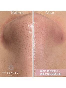 ティーティービューティー(TT Beauty)/毛穴の黒ずみは１日で撃退