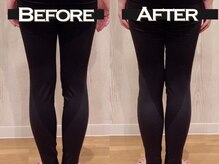 リズボディ(RizBody)/【Before After】施術1回目 