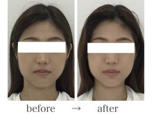 エレランサ/ビフォーアフター(20代)