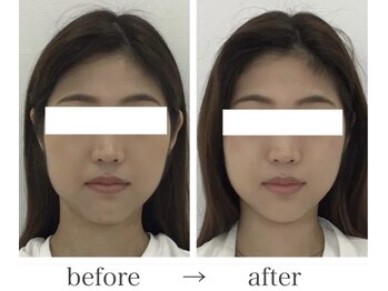 エレランサ/ビフォーアフター(20代)