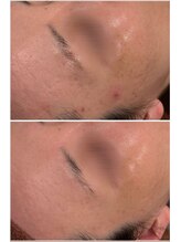 オリエンタルビューティー(ORIENTAL BEAUTY)/プラズマフェイシャル