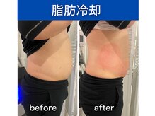 シアラ(SHIARA)/脂肪冷却１回の変化