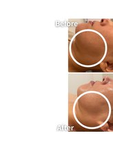 エムボーテ 太田店(M BEAUTE33)/顔筋小顔コルギ