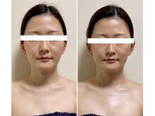 ニコワ(Nicowa)/Nicowaのコルギ★BeforeAfter