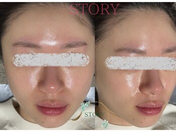 ストーリー(STORY)/眉毛と艶肌ワックス専門店