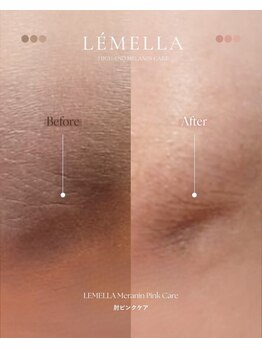 ジュエリーボディー(Jewelry body)/黒ずみケア「LEMELLA」導入！