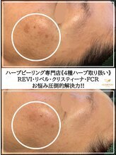 ♡専用　リベルハーブピーリングセット リベルハーブピーリング背中🌿 | ブログ | 千葉市のエステなら