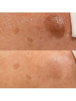 プルメリア(Plumeria)/シミケア効果