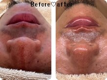 エムエー(MA)/肌育毛穴洗浄（TENNYO）・髭脱毛