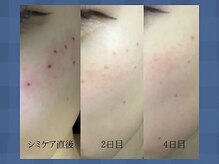 アリス 心斎橋店(alice)/★シミケア後の経過★