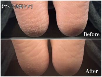 アウラ(aUla)/フットかかと角質ケア