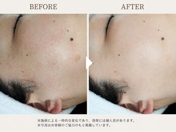 サロン ド ラジュニール(Salon de Rajeunir)/【人気No.1】ミハツ×磁気パック