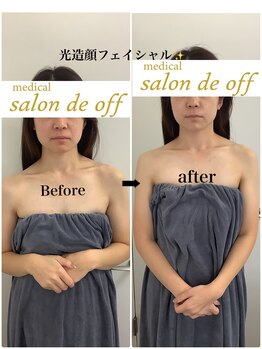 メディカルサロンドオフ 堺東店(medical salon de off)/光造顔フェイシャル★ &nbsp;施術前後