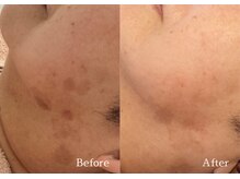 綺麗サロン 脱毛アンドフェイシャル ジュエル(Jewel)/【ポイントシミケア】