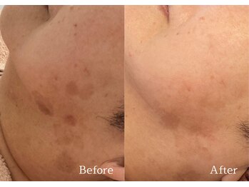 綺麗サロン 脱毛アンドフェイシャル ジュエル(Jewel)/【ポイントシミケア】