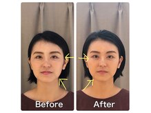 リキュア エスパース デ ボーテ 東京表参道店(ReCuA Espace de Beaute)の雰囲気（リキュア式美容鍼で目パッチリ、お顔スッキリ♪）