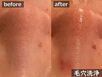 ココモンド(COCOMONDO)/ハイドロ毛穴洗浄/毛穴/毛穴洗浄