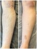 【メンズ美肌全身脱毛】顔ありVIOなし25500→17600