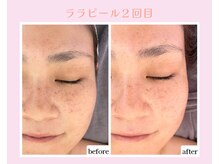 カレン アイビューティー(Karen Eyebeauty)/ララピール２回目☆