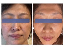 エヌプラスビューティー(N+beauty)の雰囲気（メソポレーション&小顔フェイシャル　難しいシミにもオッケー！）