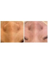 ローゼ(ROSE)/【毛穴洗浄】【韓国肌】【艶肌】