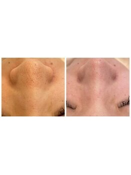 ローゼ(ROSE)/【毛穴洗浄】【韓国肌】【艶肌】