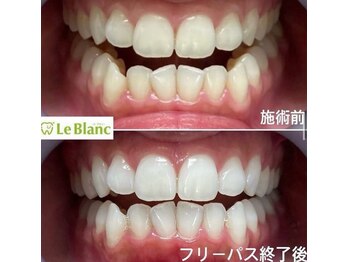 ルブラン 奈良店(Le Blanc)/しっかり白く！