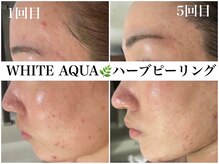 アワピール 天王寺店(AWA PEELL)/ハーブピーリング/ニキビケア